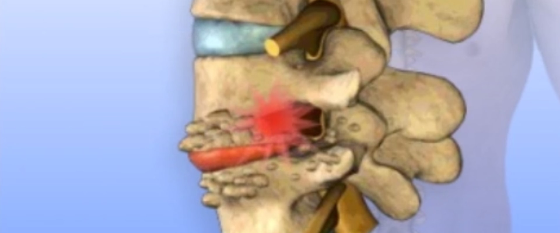 Understanding Degenerative Disc Disease