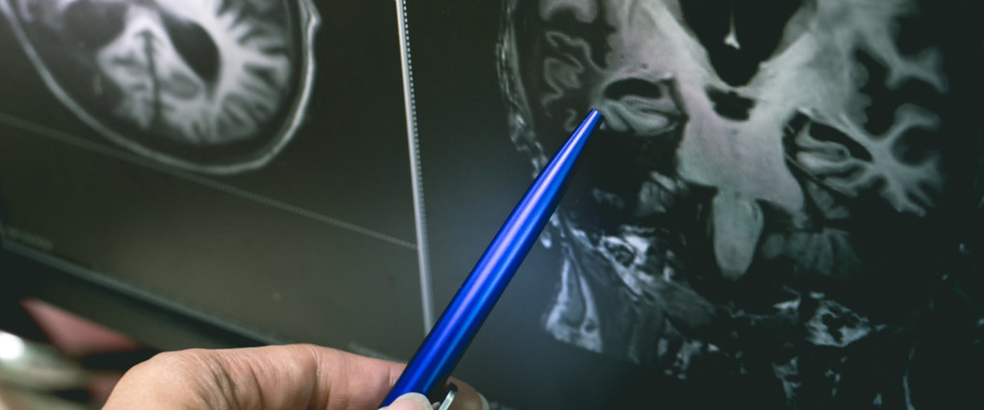 MRI Scans: A Comprehensive Overview