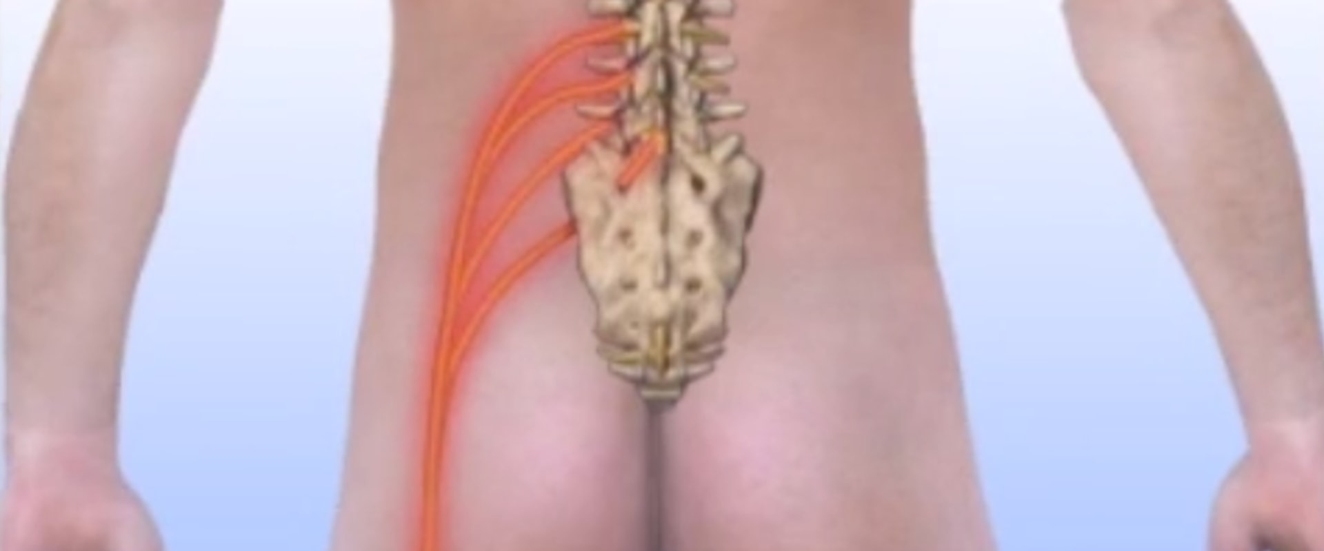 Understanding Radiculopathy: Types, Symptoms, and Treatment