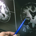 MRI Scans: A Comprehensive Overview