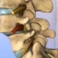 Spondylolisthesis - All You Need to Know
