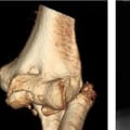 Understanding Fracture-Dislocations