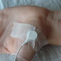 EMG/NCV Studies: What You Need to Know